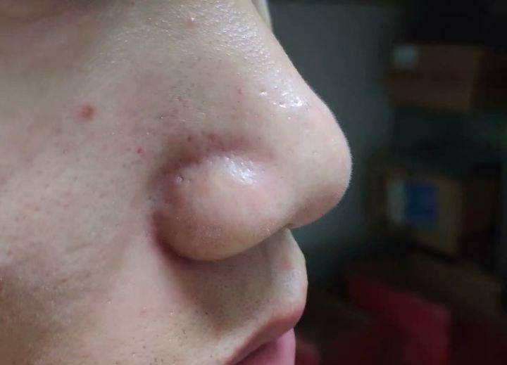 "脂质微丝"到底是什么?鼻子上挤的白条条的东西是脂质微丝吗?