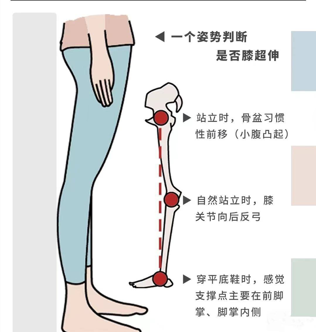 自然站立时,膝关节向后反弓如果以下情况中,你中了至少2条,就可能存在