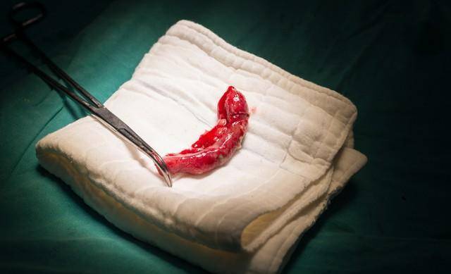 提高免疫,调节肠菌群,减少病症,阑尾这么有用,切掉是否太可惜_盲肠