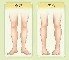 ①外八字走路这种走路姿势,时间久了容易养成xo型腿,看起来就会有小腿
