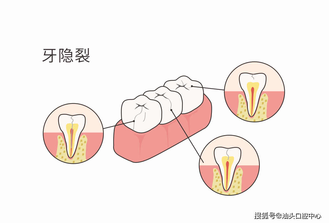 非遗 牙齿断裂（牙齿断裂是缺什么元素吗） 第3张