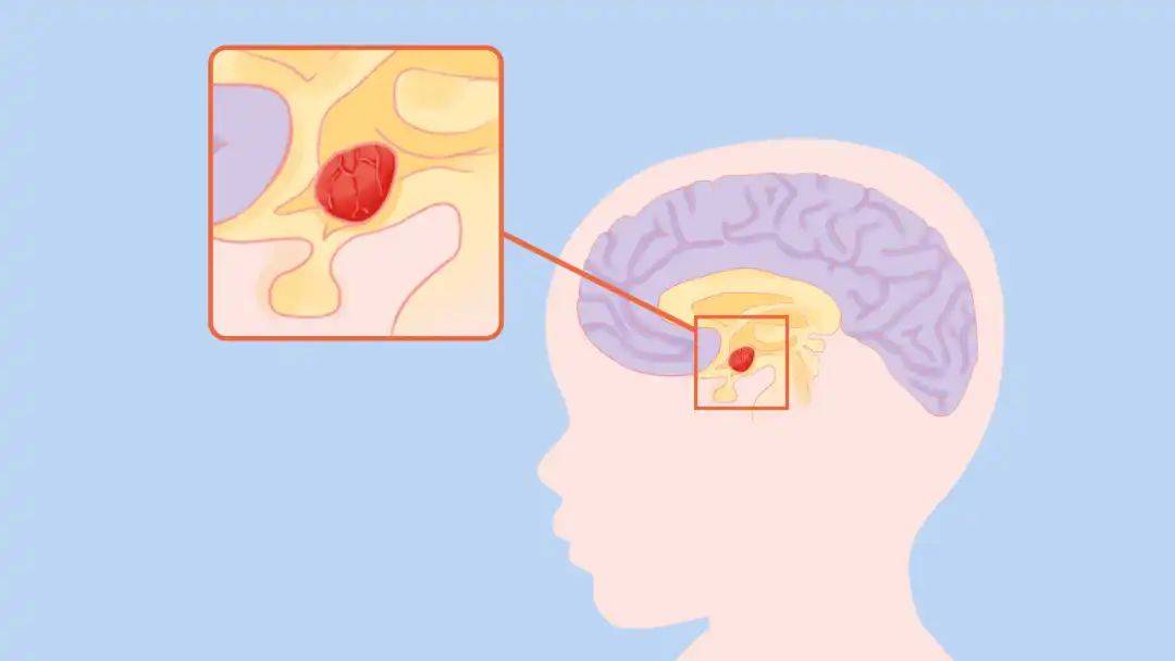 脑瘤患者早期4大症状常被忽视!这样吃可预防_肿瘤_饮食_食物