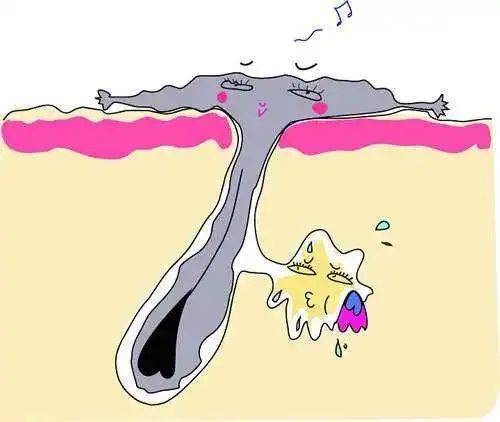 油脂_毛孔_长痘痘