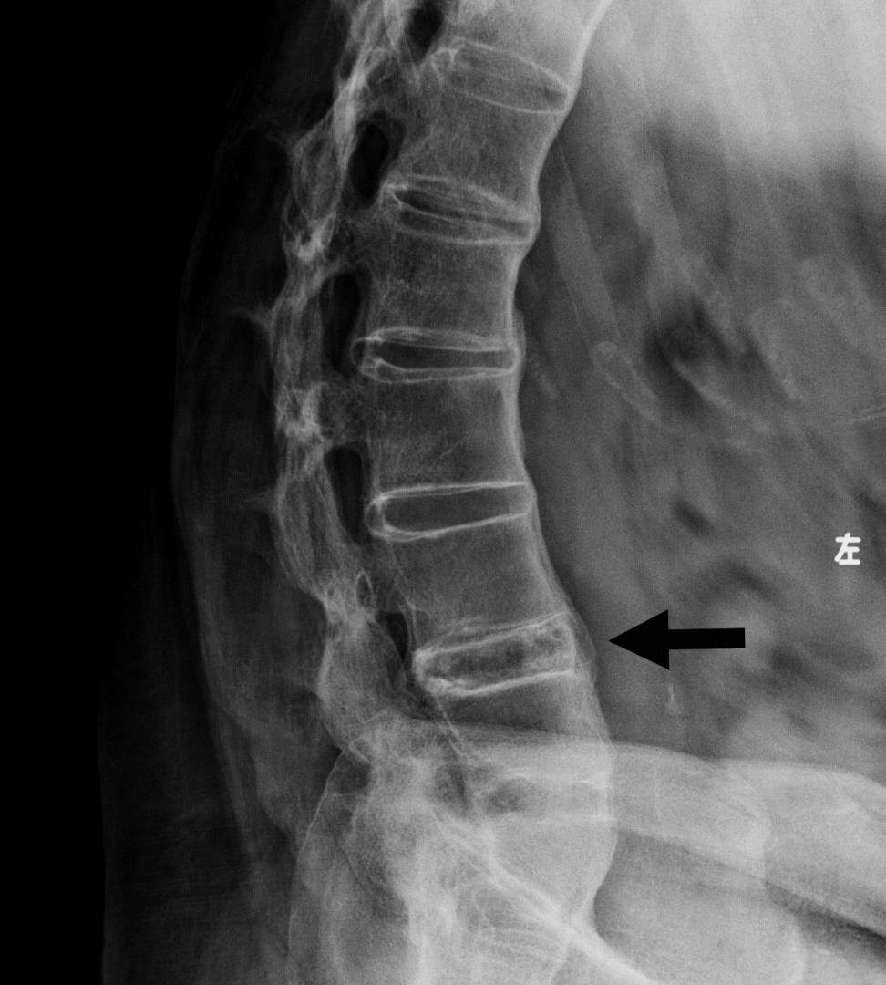 强直性脊柱炎x线图片图片