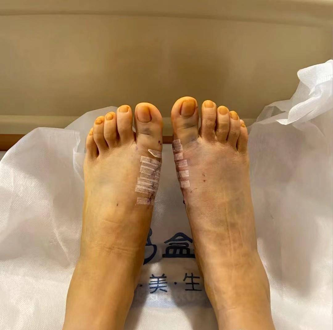 拇外翻术后有关伤口恢复愈合问题,术后患者注意收藏保存!