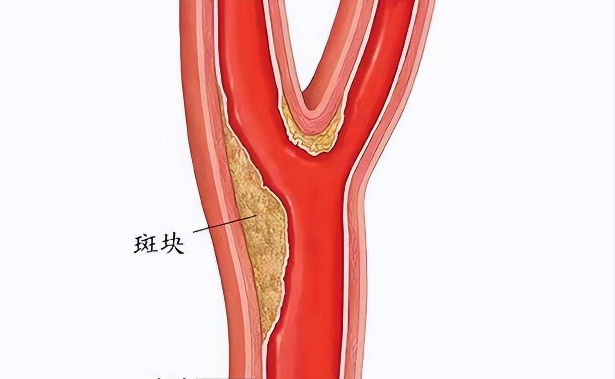 中年男子患颈动脉斑块,吃了3年他汀,看看现在的检查化验结果_方力