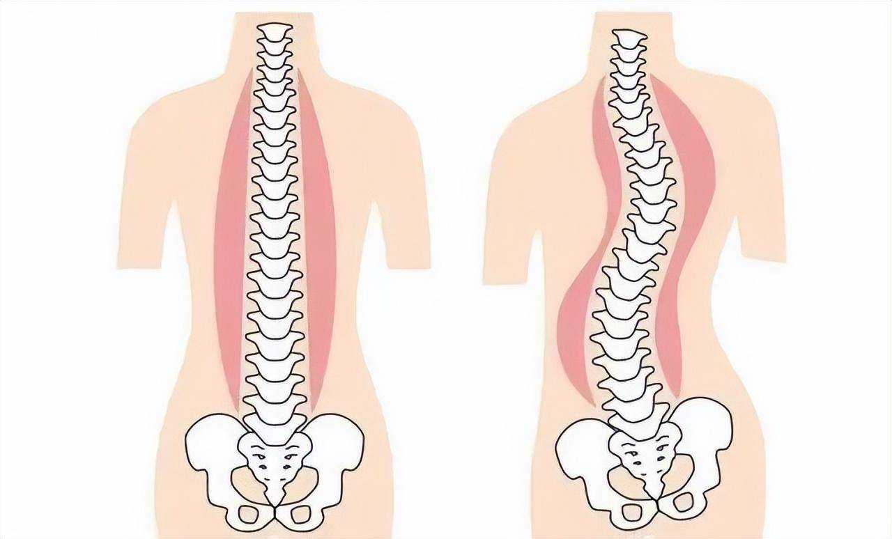 脊柱侧弯发病率图片