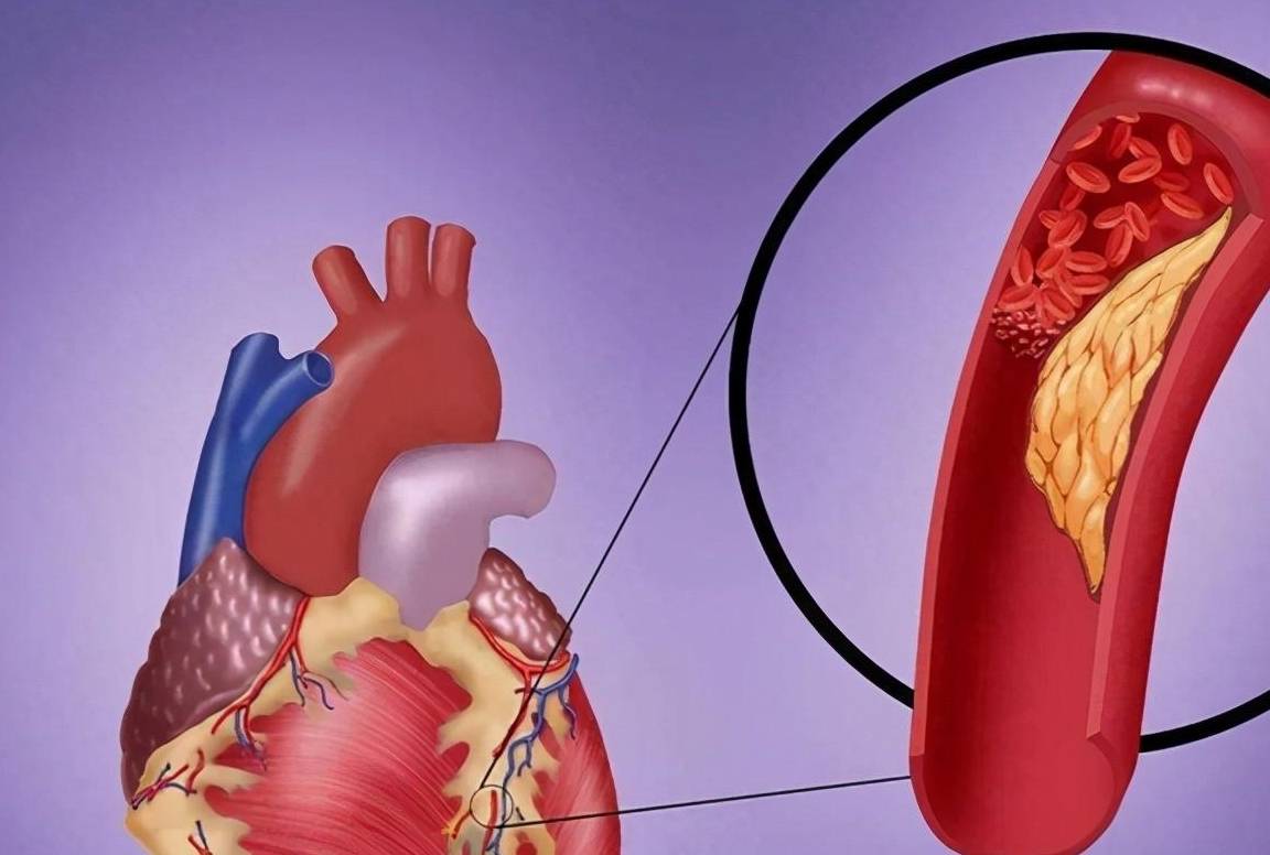 原创            胆固醇高，甘油三酯高，不吃降脂药能好吗？这是为什么？