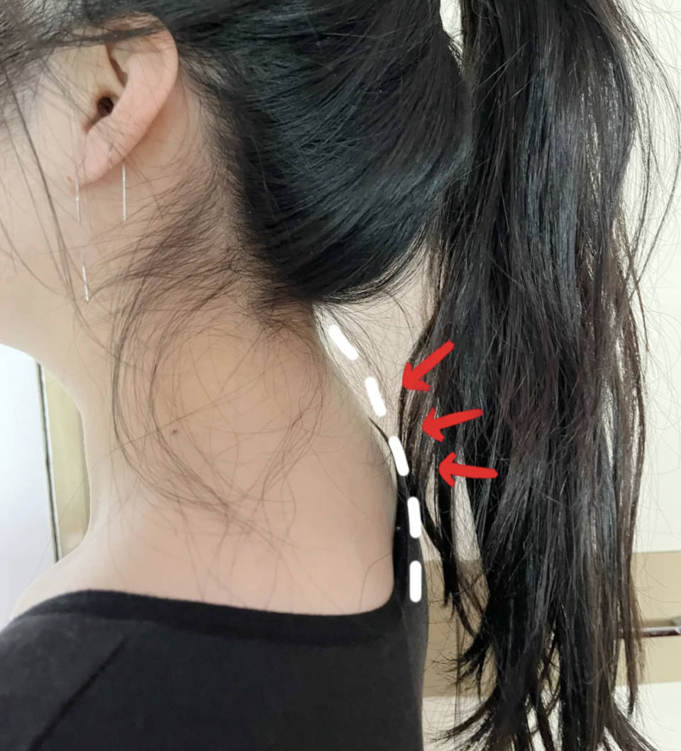 康复者曝光治疗细节,抓紧收藏学习!_感觉_脖子_比较严重