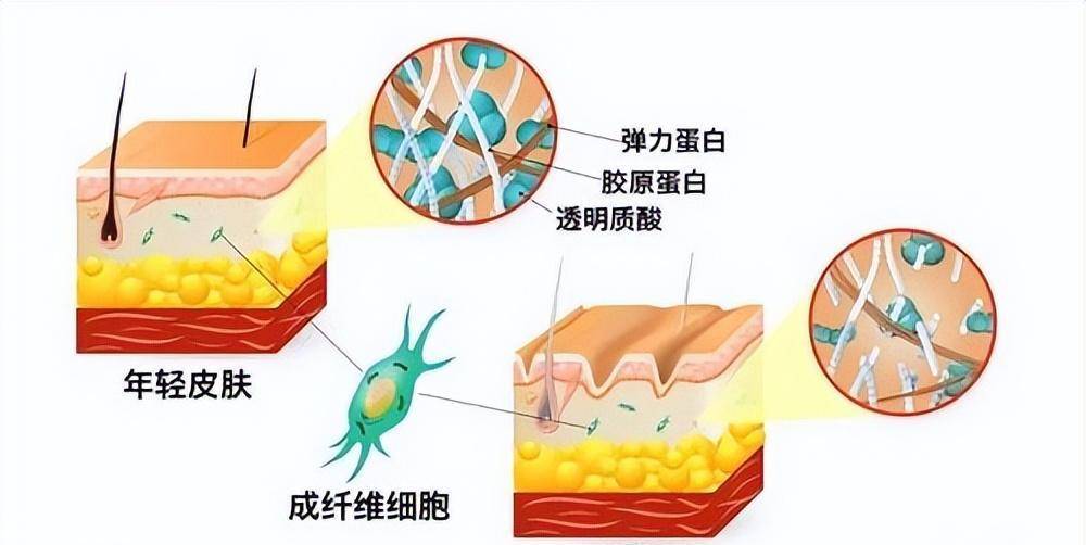 成纤维细胞数量下降,胶原纤维,弹力纤维产生断裂,皮肤逐渐出现老化