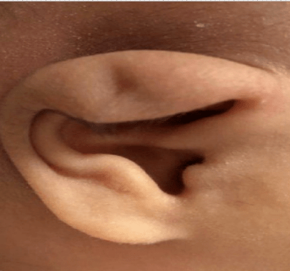 新生儿耳朵畸形种类图片