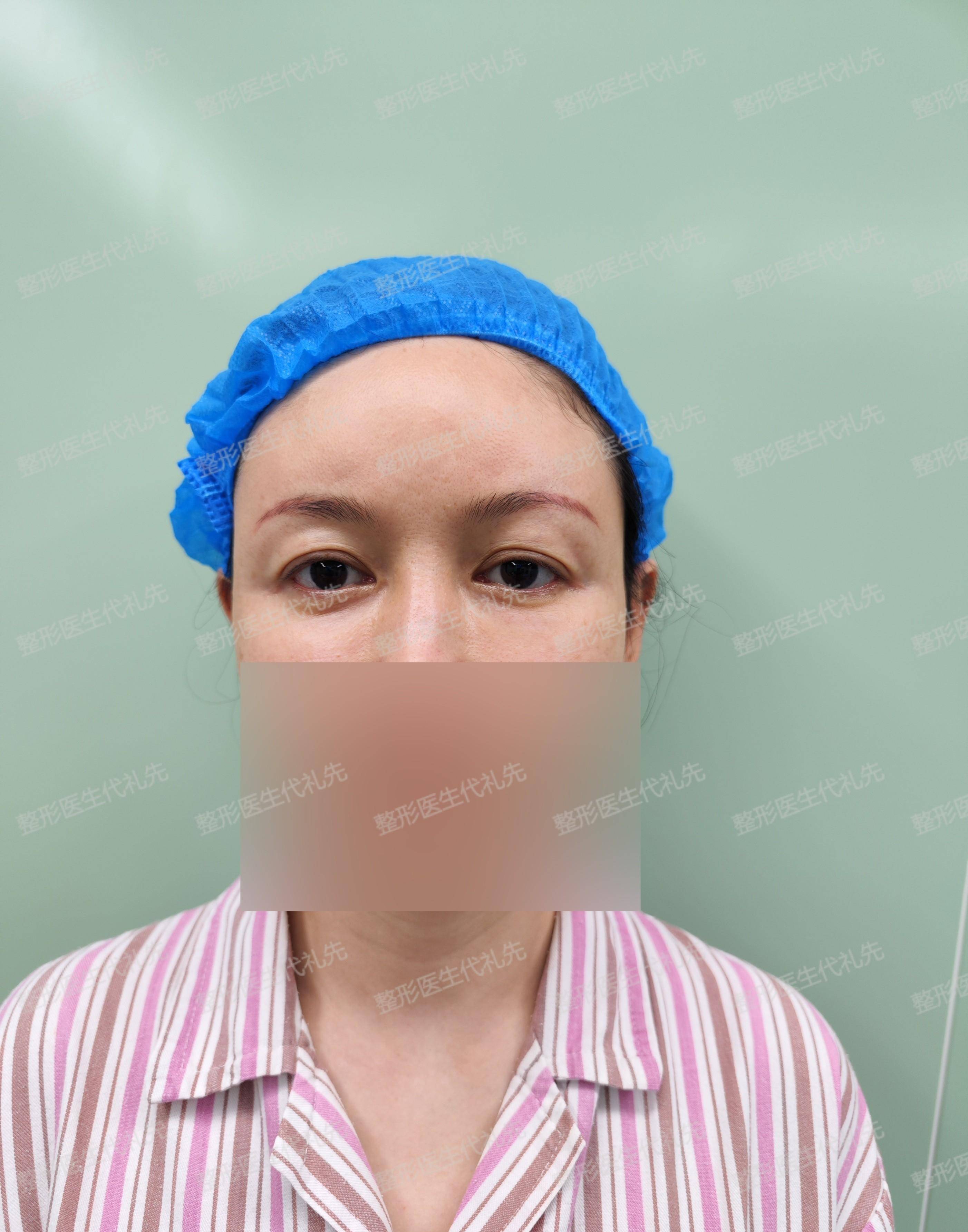 43岁女士来北京做了筋膜悬吊提眉手术,术后2周高清照片对比