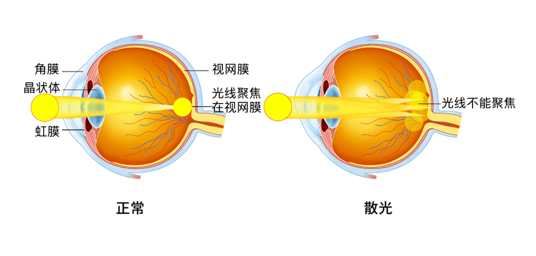 儿童眼睛散光是怎么回事 孩子散光什么情况下需要治疗