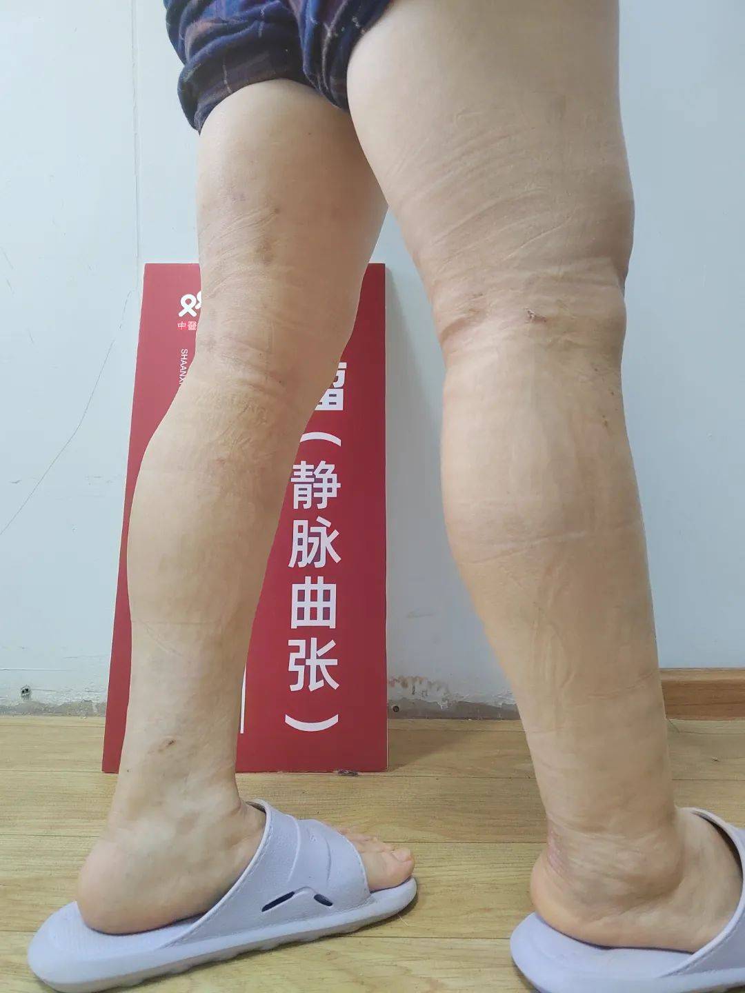 双博中医吴大健主任案例 | 下肢静脉曲张不手术,中医保守施治有良效