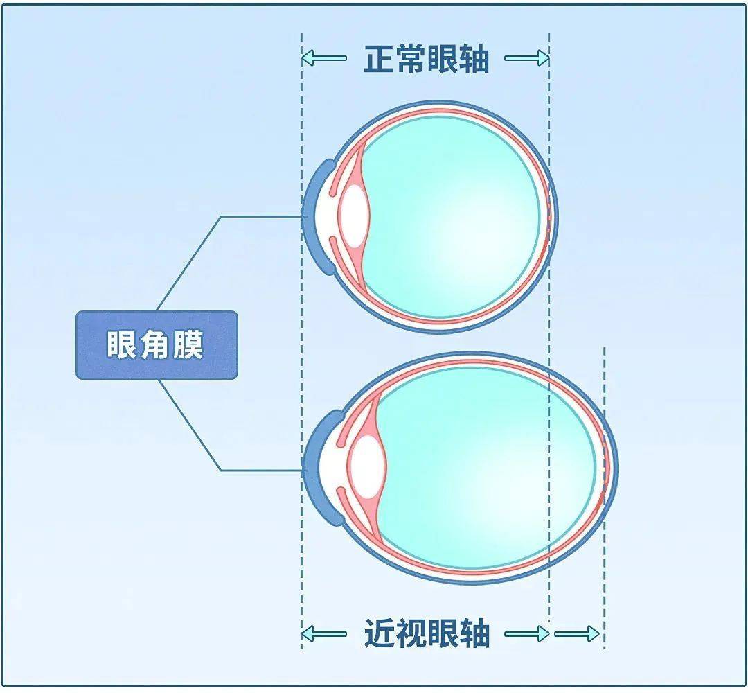 家长提问:眼轴有多重要?_视力_孩子_长度