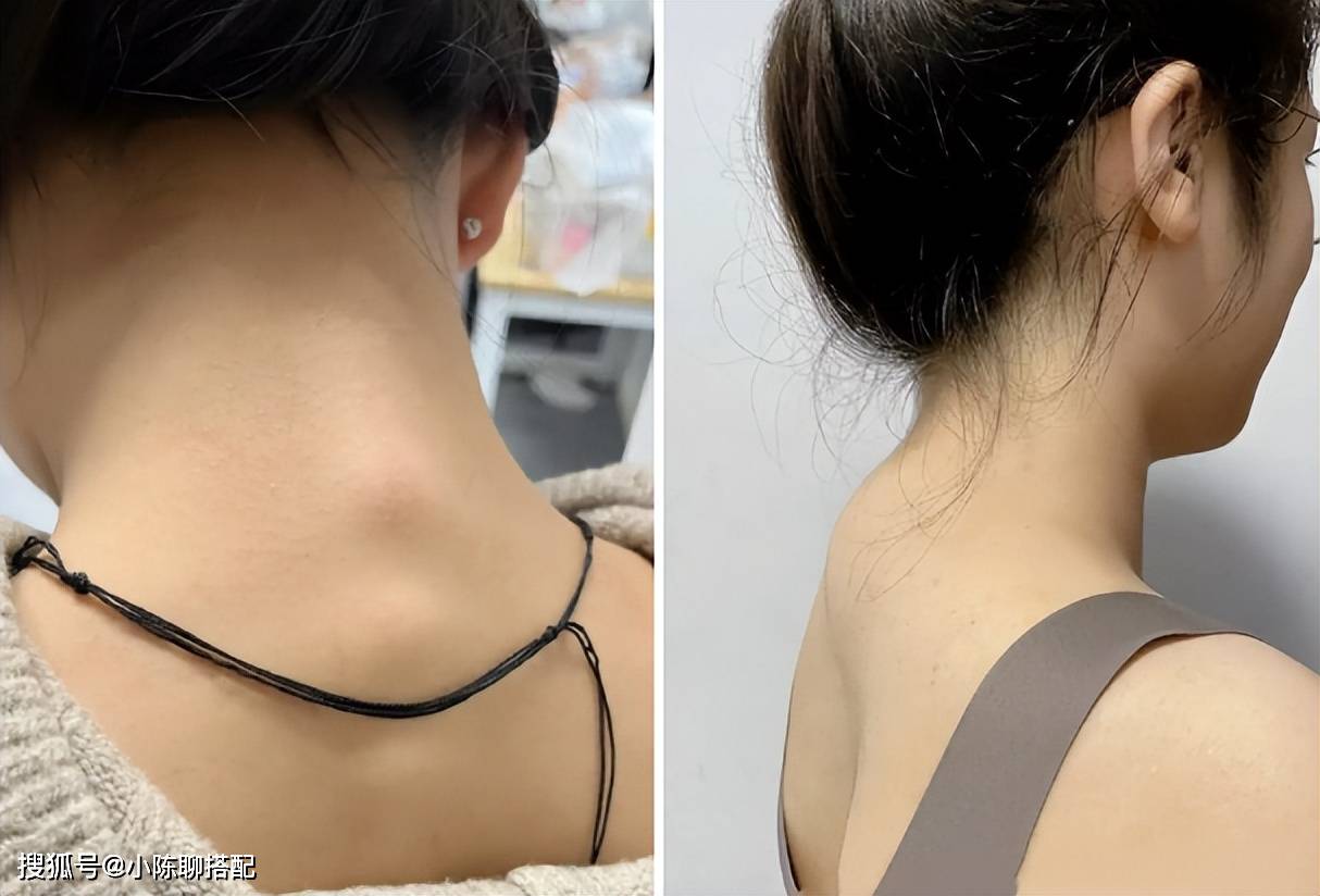 而大多数人也都有轻度的富贵包,日常当中可能不太