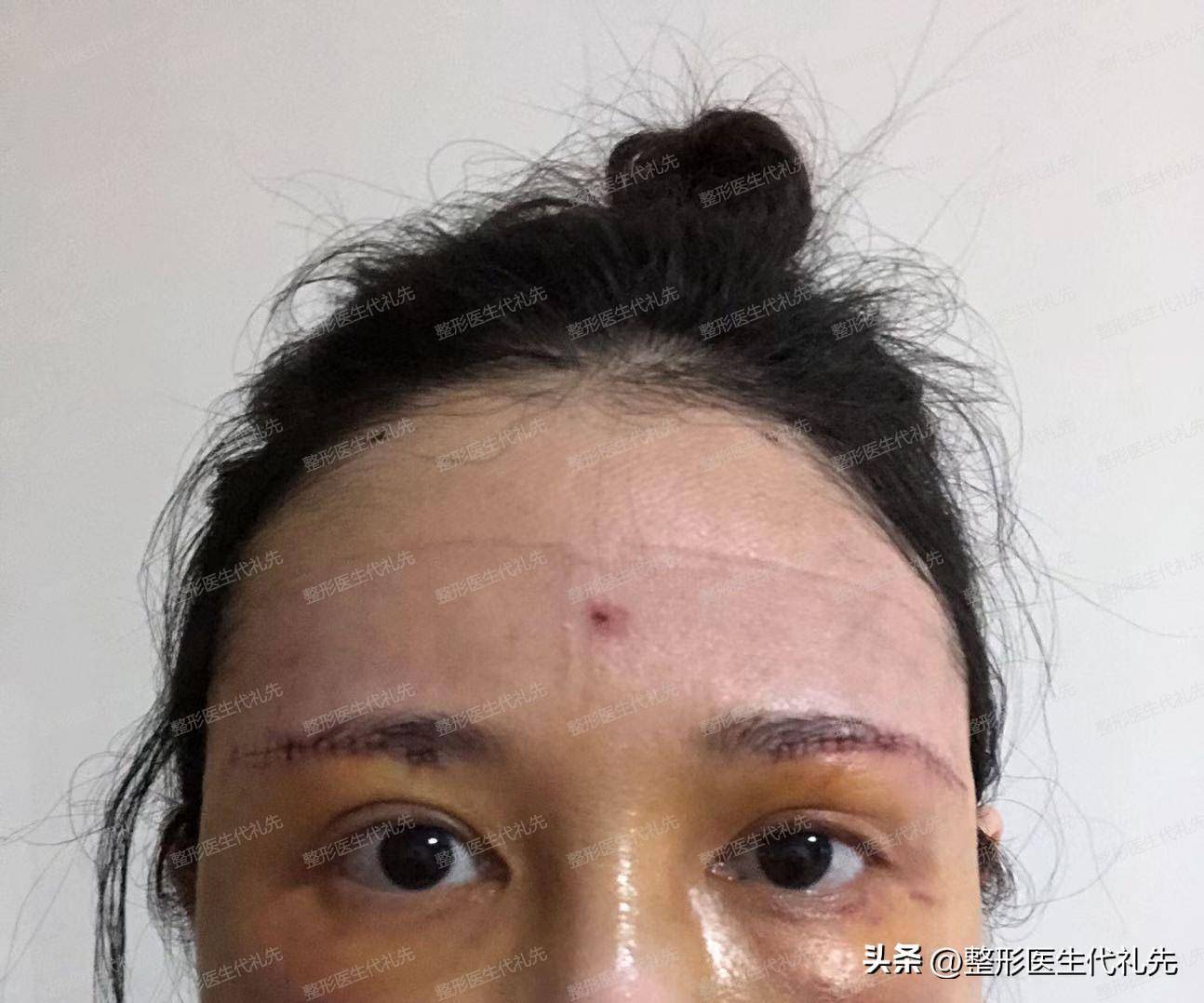 女士說了三個擔憂的主要問題:疤痕問題 提眉手術中,醫生會進行深層次