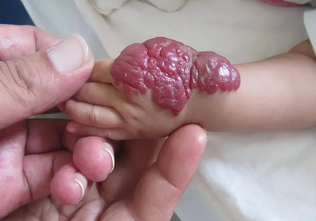 婴儿肛门长息肉图片