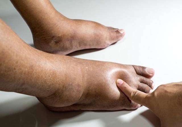 糖尿病足,是糖尿病患者晚期一种严重的并发症,最严重时可导致患肢,趾
