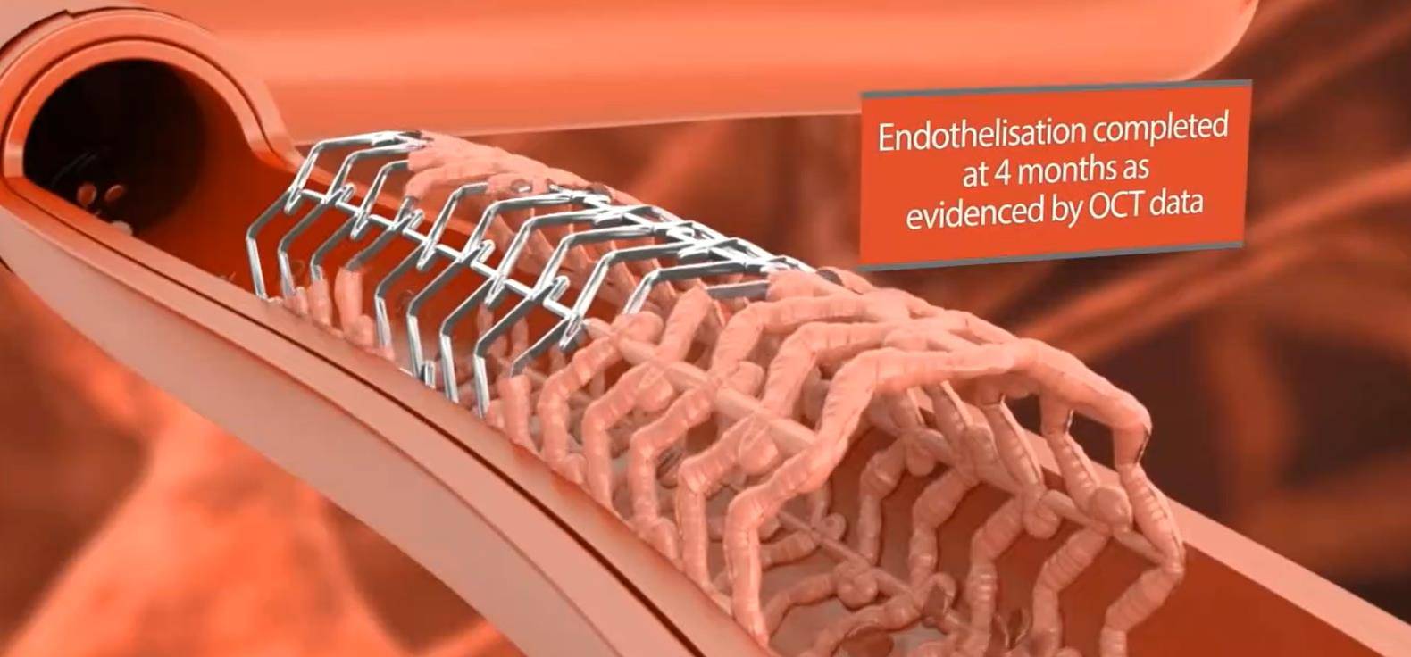 装支架前,这些得知道!_血管_药物_治疗