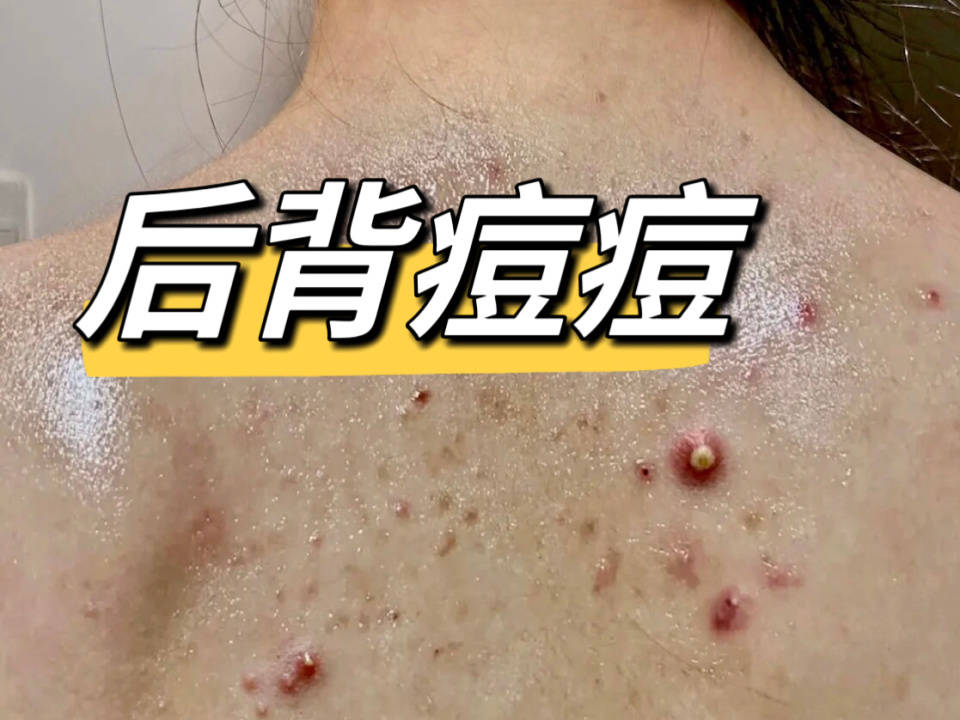 后背脓包又多又恶心!照着这个方法做!在家轻松洗出健康美背!