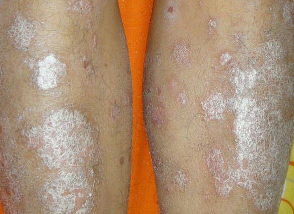 长沙专业治疗银屑病牛皮癣:身上长白花花的牛皮癣是什么原因引起的?