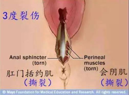 顺产侧切位置图片