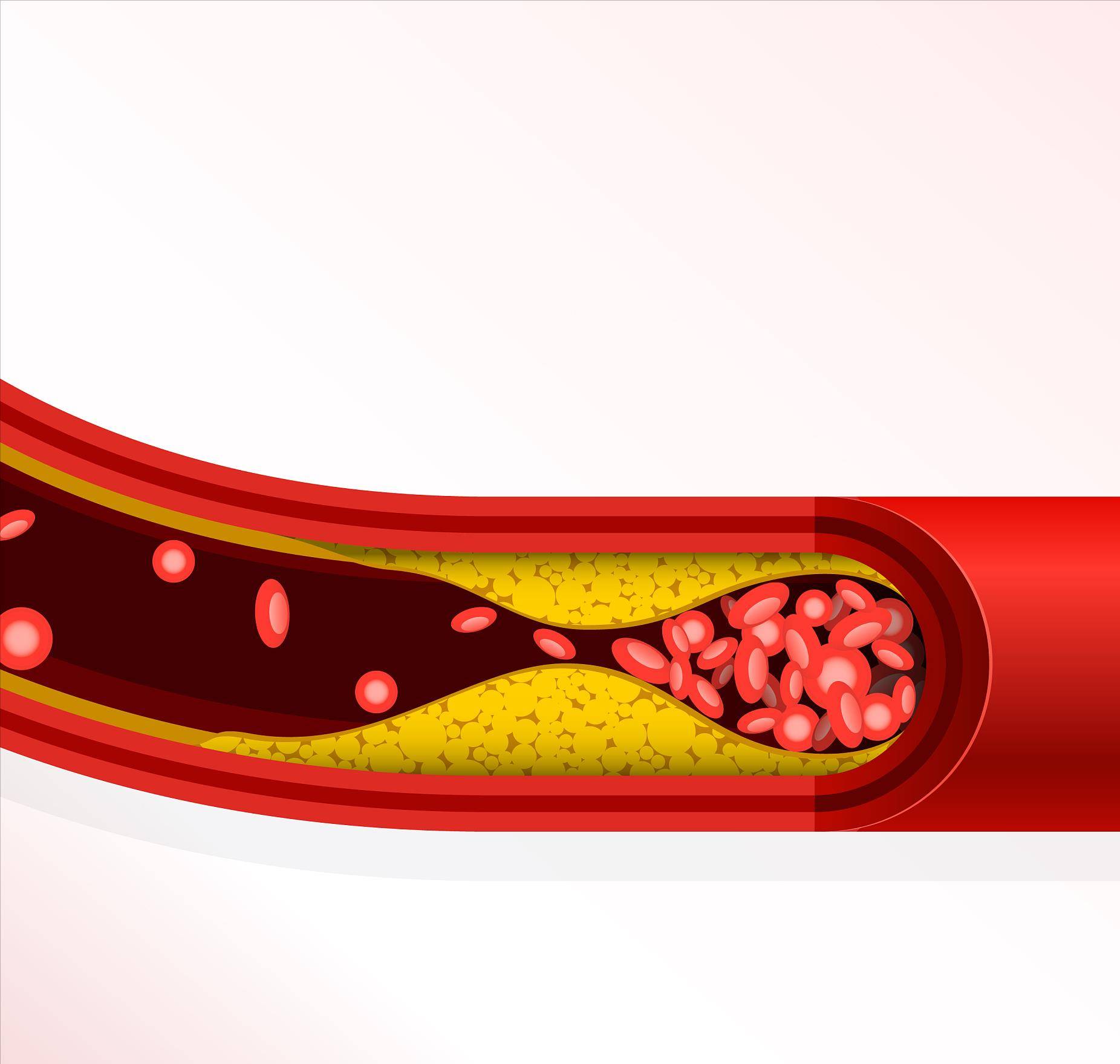 血管斑块图示图片