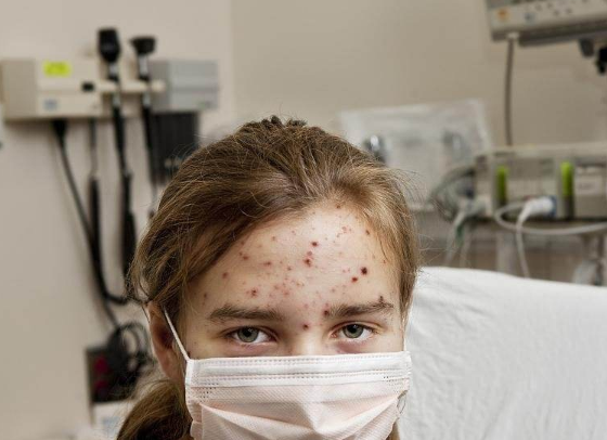 感染艾滋病的人,过了多久才会被发觉?或许还有人当做皮肤病治疗