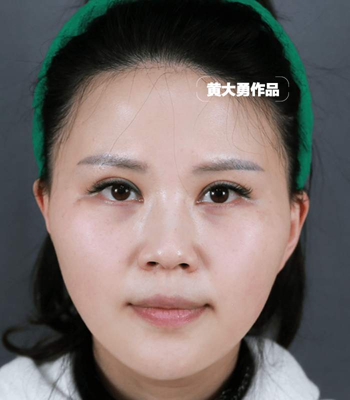 30岁女生做完颧骨内推1个月,年轻5岁_面部_姑娘_手术