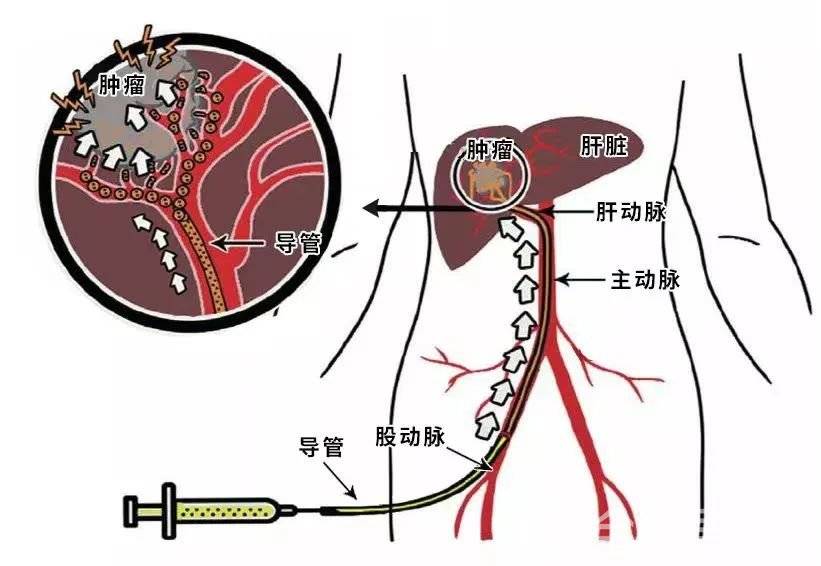 "通知导管室,准备进行tips手术.