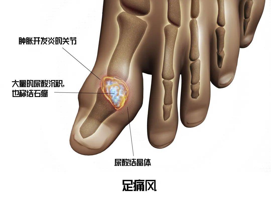 小迈课堂|小迈带你了解痛风~