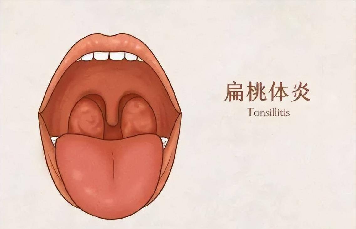 扁桃体炎又称"乳蛾",古代医家是如何诊断治疗的?_风热_咽部_发病