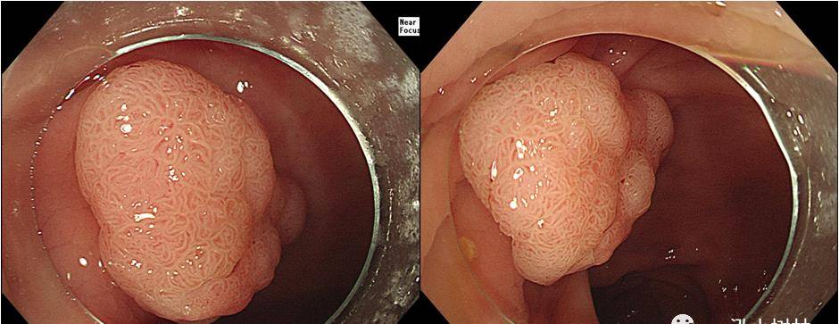 良性肠息肉图片直肠图片