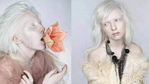 白化病能活多久_皮肤_人们_正常人