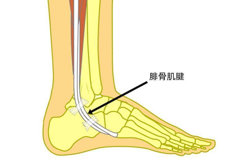 腓骨肌腱损伤是什么感觉脚踝外侧疼痛和压痛