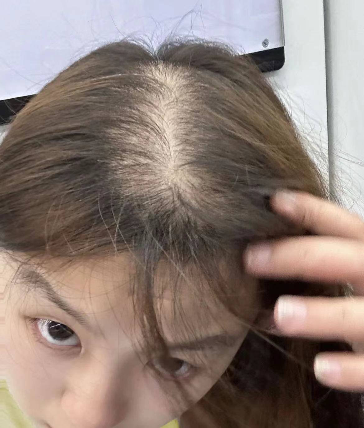 头顶发量稀疏露头皮?学会这几招轻松实现发量暴增!_头发_效果_毛囊