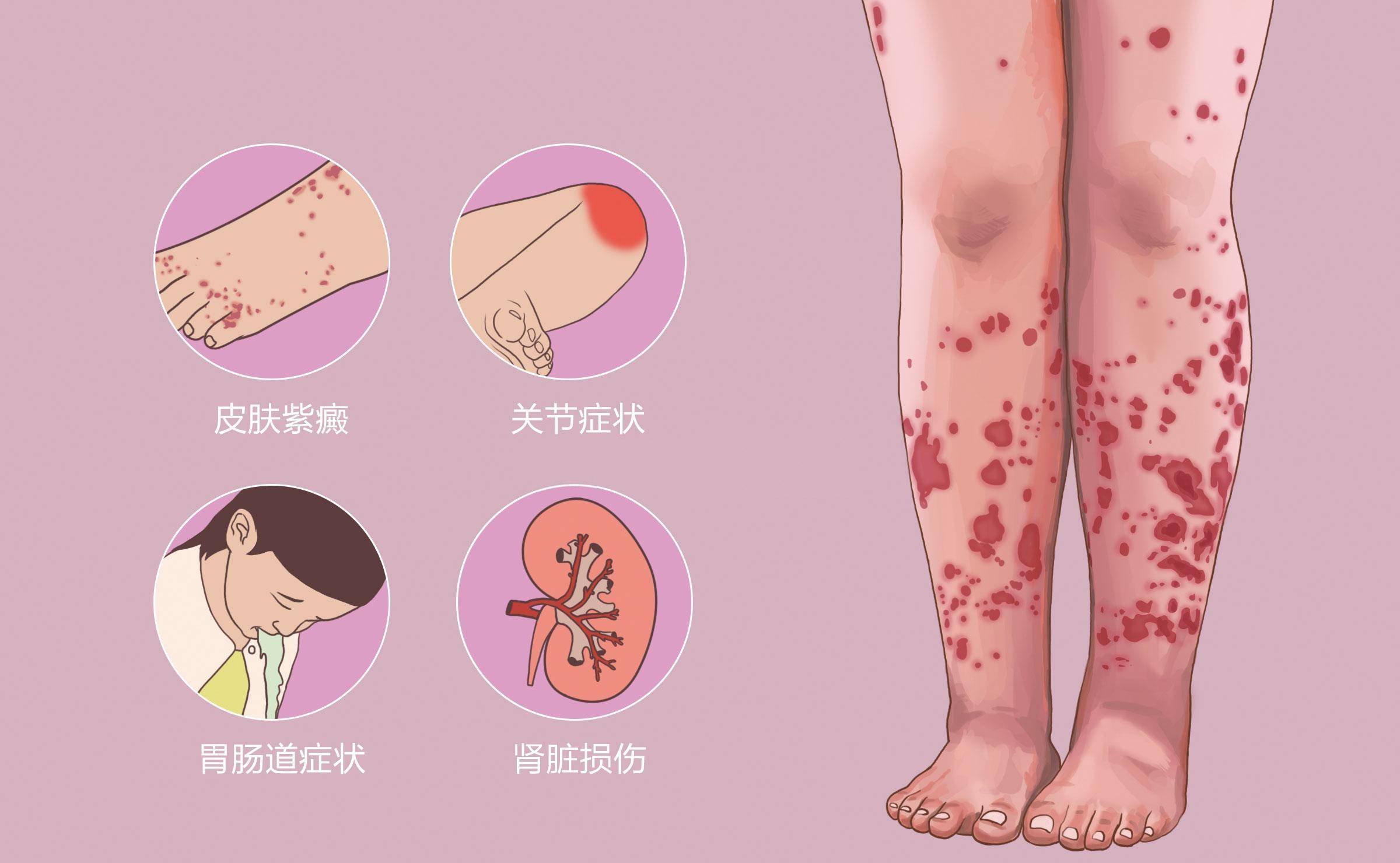 过敏性紫癜为什么反反复复_患者_体质_问题