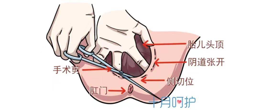 剖腹产切口位置图图片
