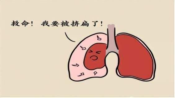 关于气胸你了解多少?_治疗_患者_胸腔