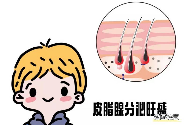 严重的痘痘怎么办 痘痘越来越严重-很严重的痘痘能好吗图片