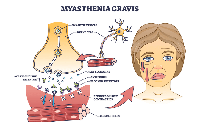 冯慧宇教授:医患携手优化疾病管理,"托起"重症肌无力患者人生_治疗