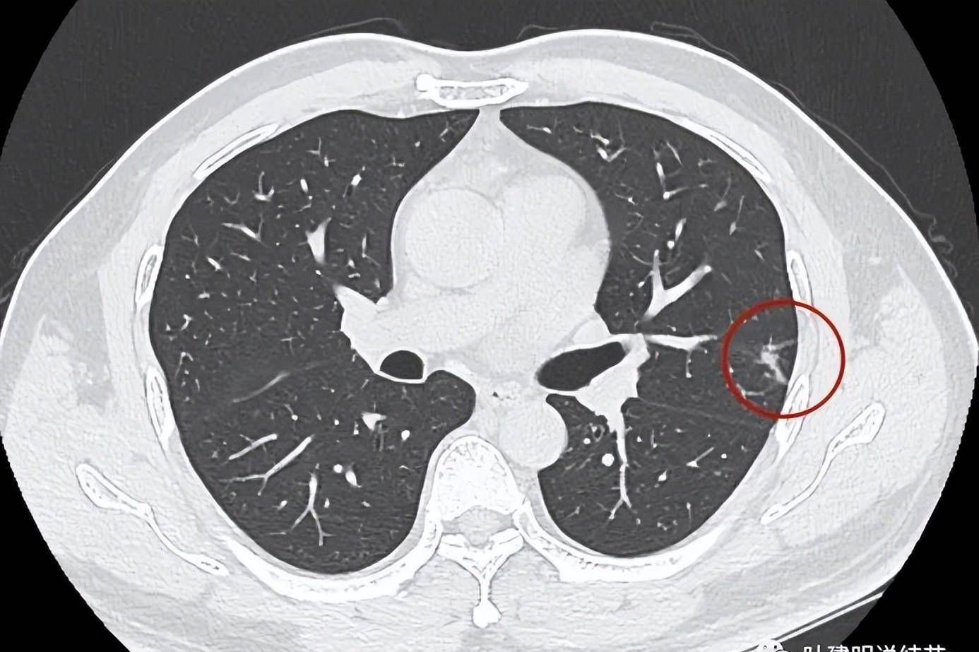 这样的肺实性结节,即便pet