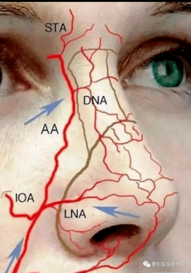 知名鼻整形专家刘大强医生:注射微整形隆鼻导致栓塞的临床表现和处理