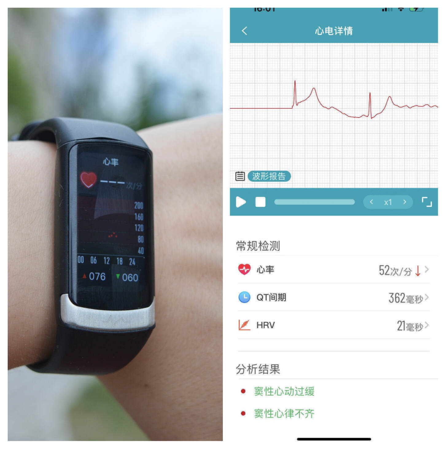 动态监测,健康可视化:dido f50s pro大屏血糖血压智能手环体验_体温