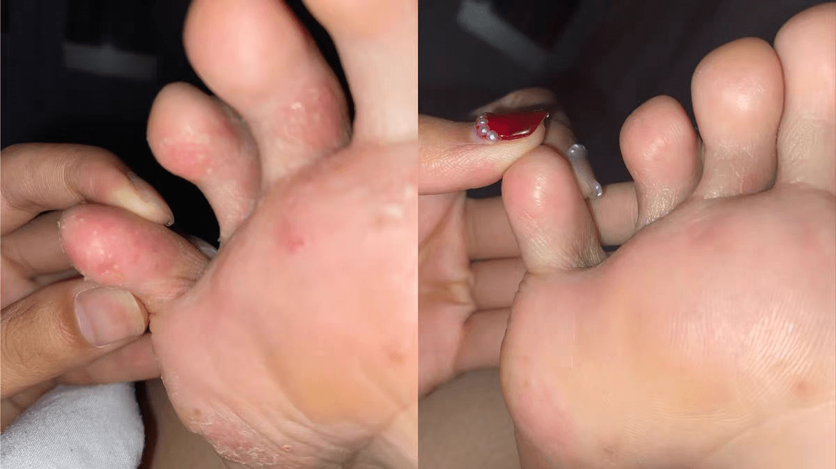 红霉素软膏真的能治脚气吗?