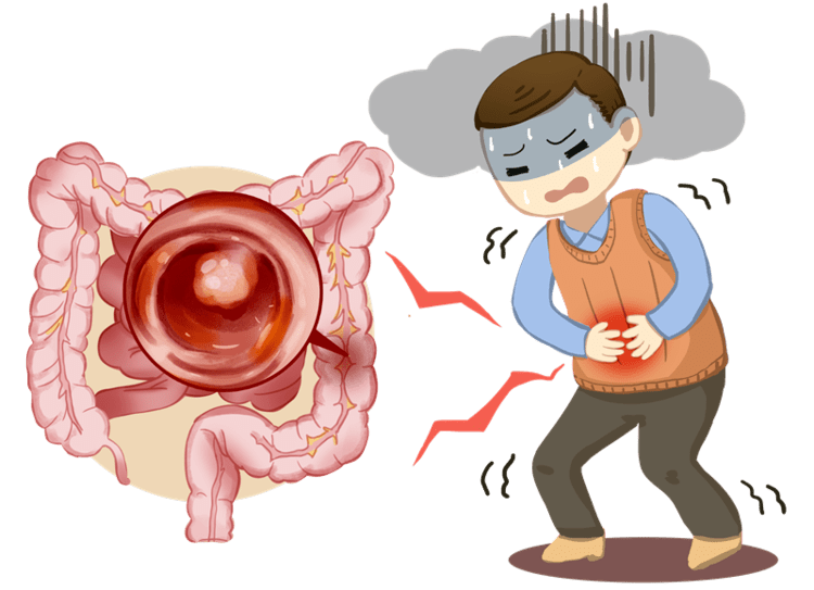 发现胃肠息肉怎么办?预防请记住这六点