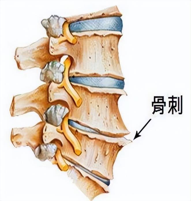 30岁后预防骨刺,要做这件事