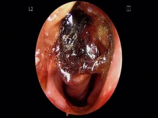 而鼻腔的容积是有限的,鼻腔粘膜长时间受到膨胀的海绵宝宝的挤压,会