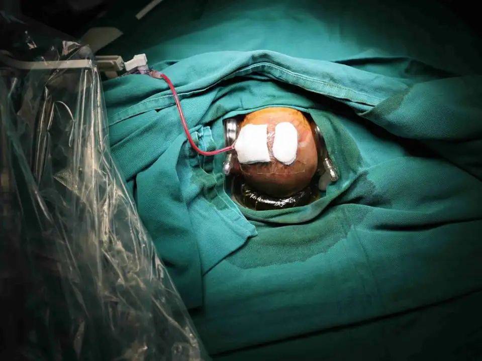 术后包扎手术结束04任重而道远未来将造福更多患儿northwest womens